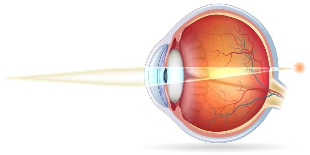 Die schematische Darstellung eines weitsichtigen Auges