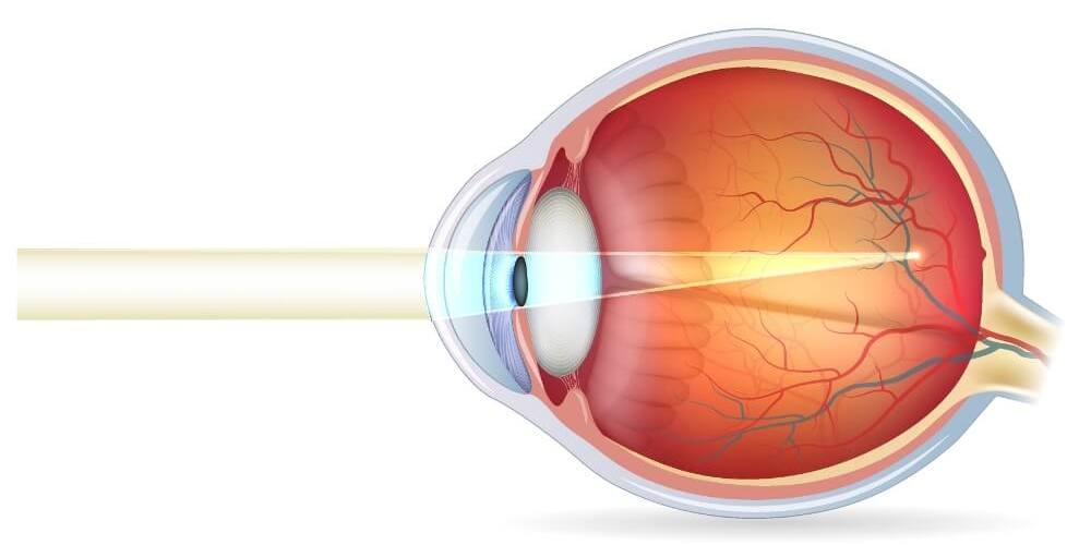 Die schematische Darstellung eines kurzsichtigen Auges
